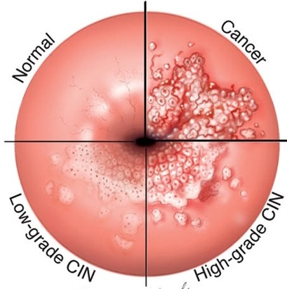 正常女性可以切除子宫吗,正常女性可以去切除子宫吗