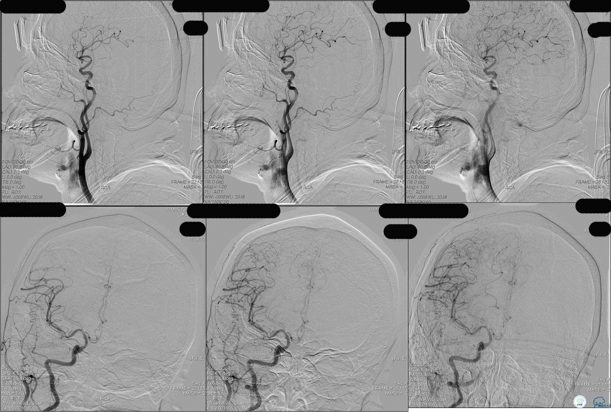 冠状动脉慢性闭塞的介入治疗,颅外段锥动脉狭窄的介入治疗
