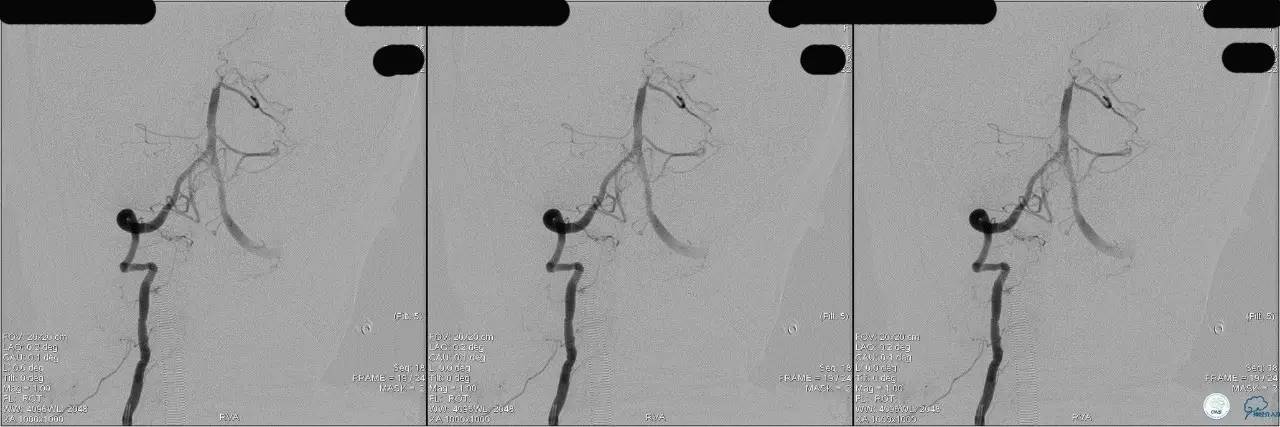 冠状动脉慢性闭塞的介入治疗,颅外段锥动脉狭窄的介入治疗
