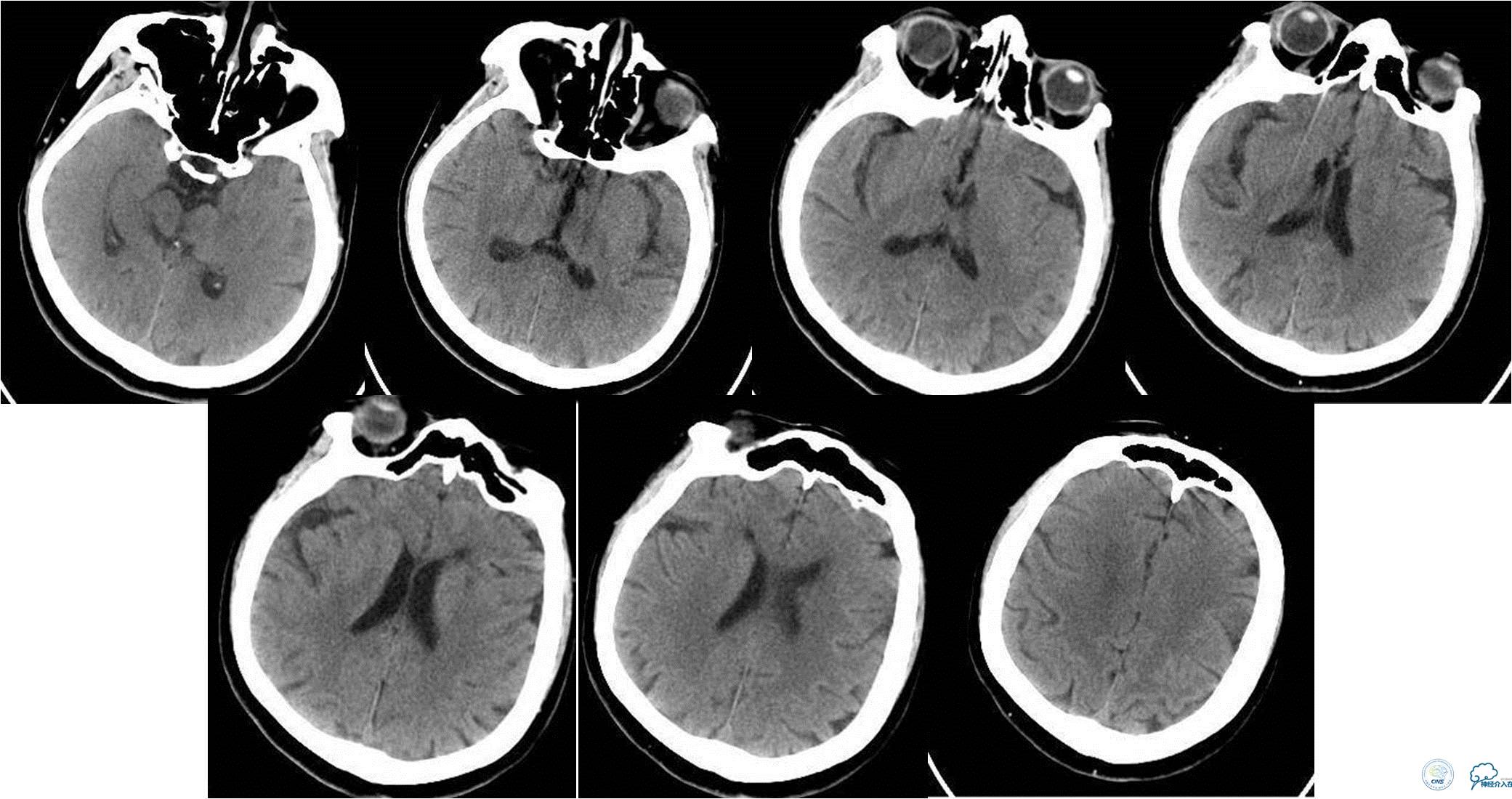 冠状动脉慢性闭塞的介入治疗,颅外段锥动脉狭窄的介入治疗