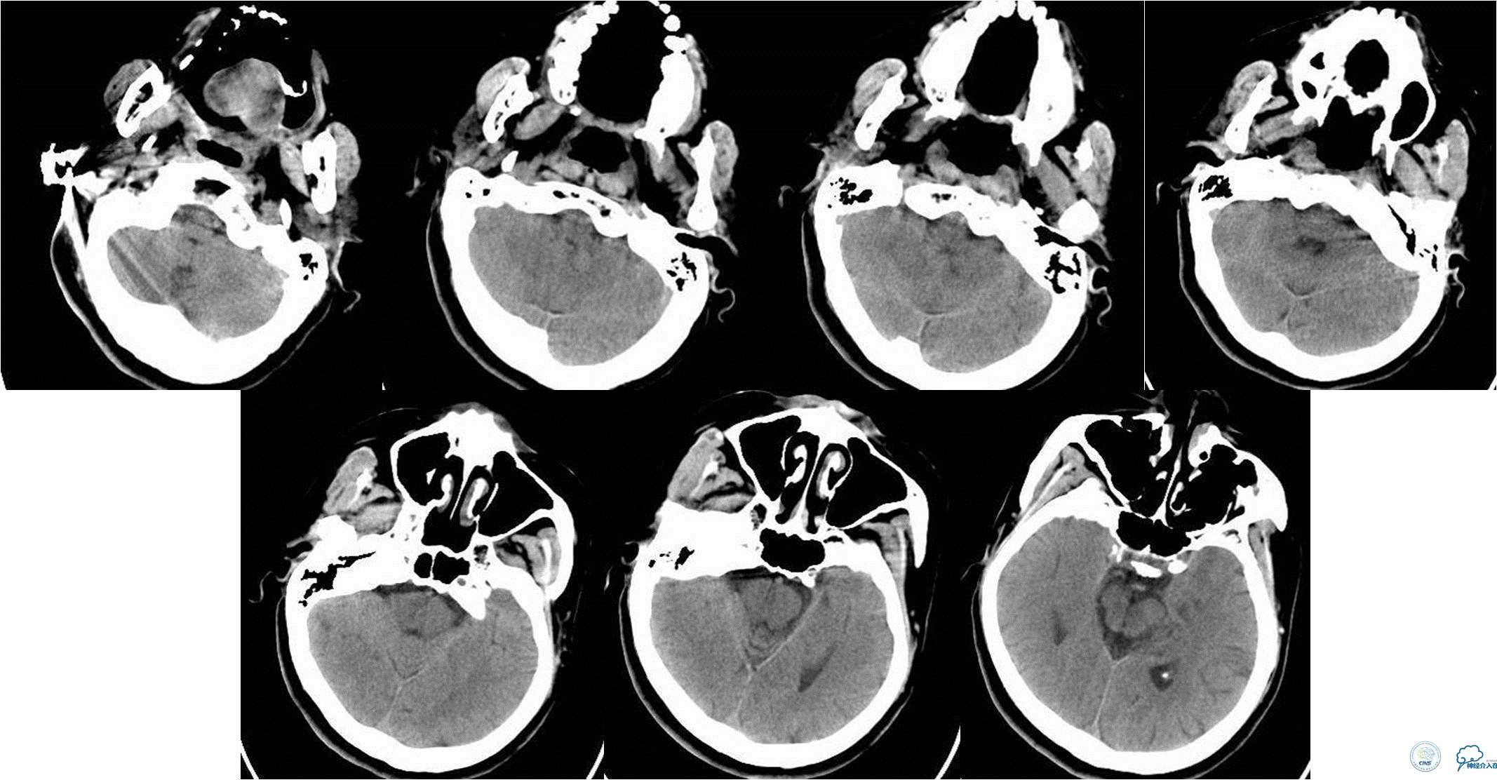 冠状动脉慢性闭塞的介入治疗,颅外段锥动脉狭窄的介入治疗