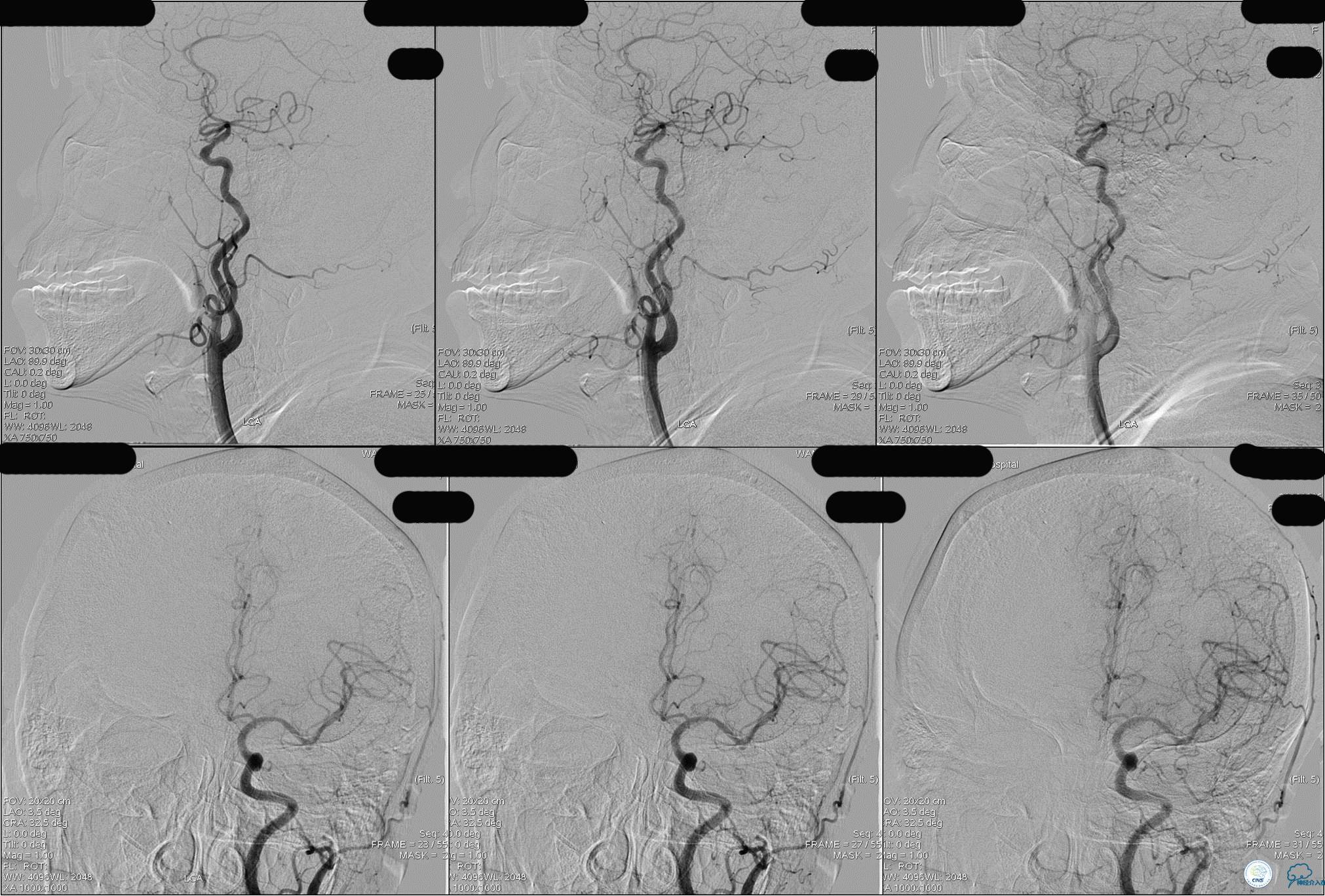 冠状动脉慢性闭塞的介入治疗,颅外段锥动脉狭窄的介入治疗