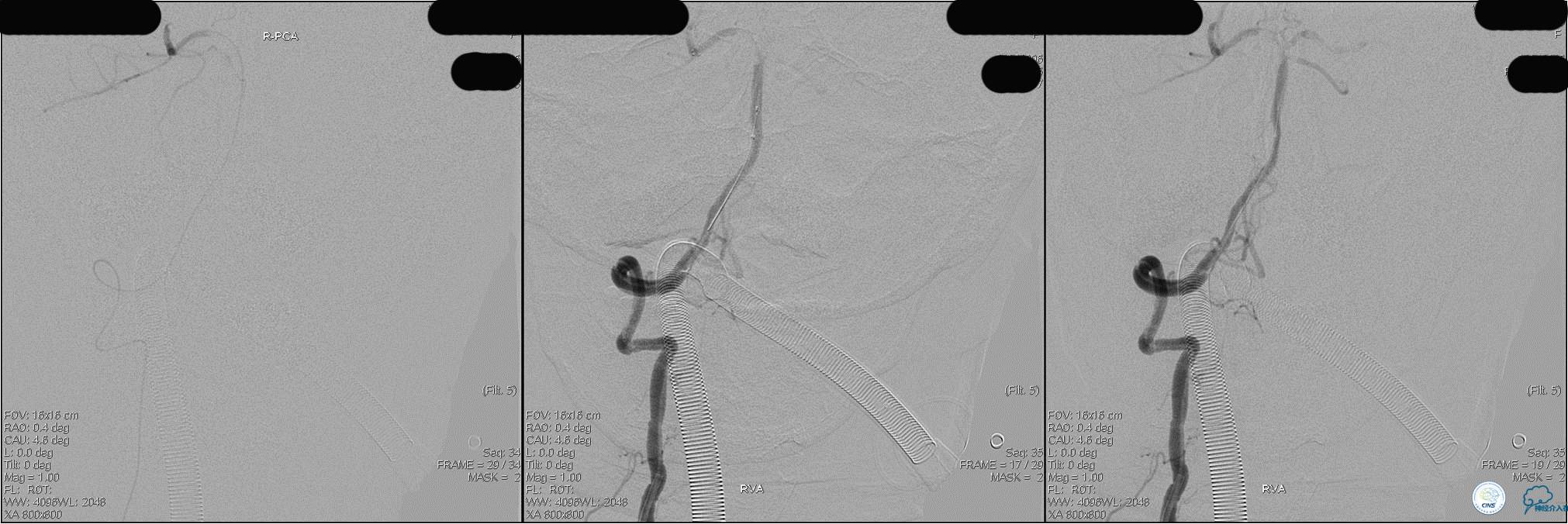 冠状动脉慢性闭塞的介入治疗,颅外段锥动脉狭窄的介入治疗