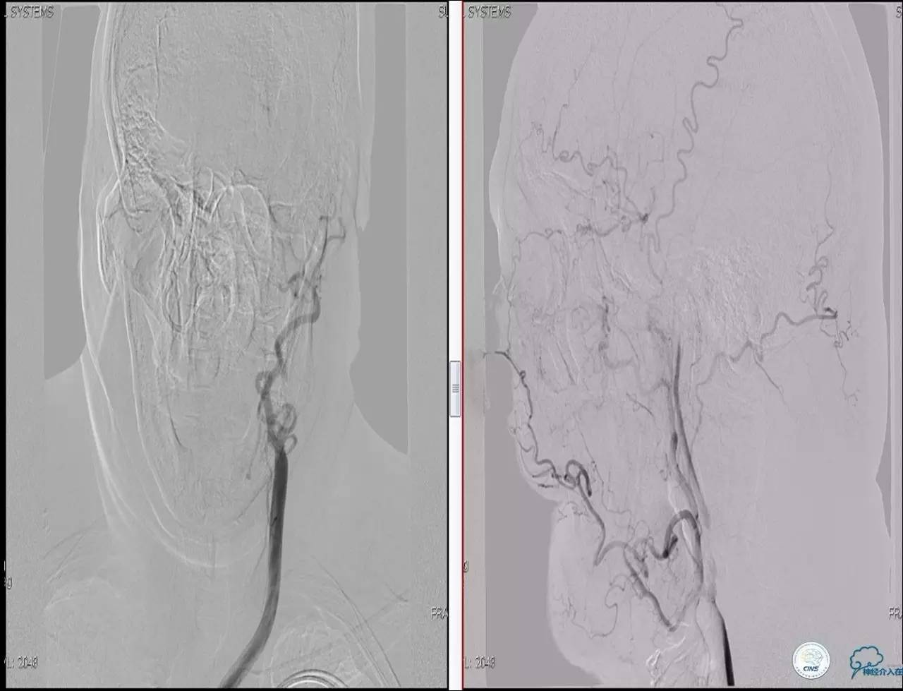 颈动脉次全闭塞,颈动脉次全闭塞中医疗法