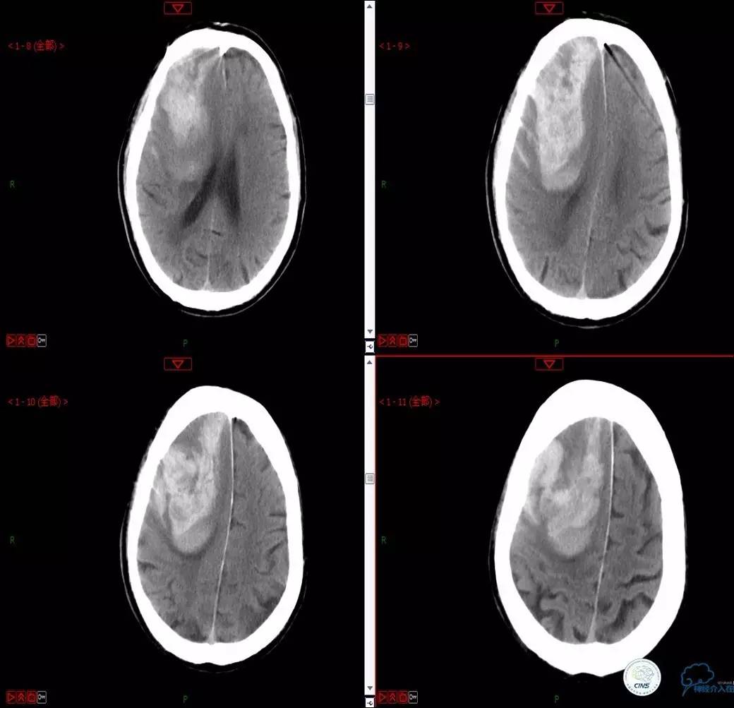 颈动脉次全闭塞,颈动脉次全闭塞中医疗法