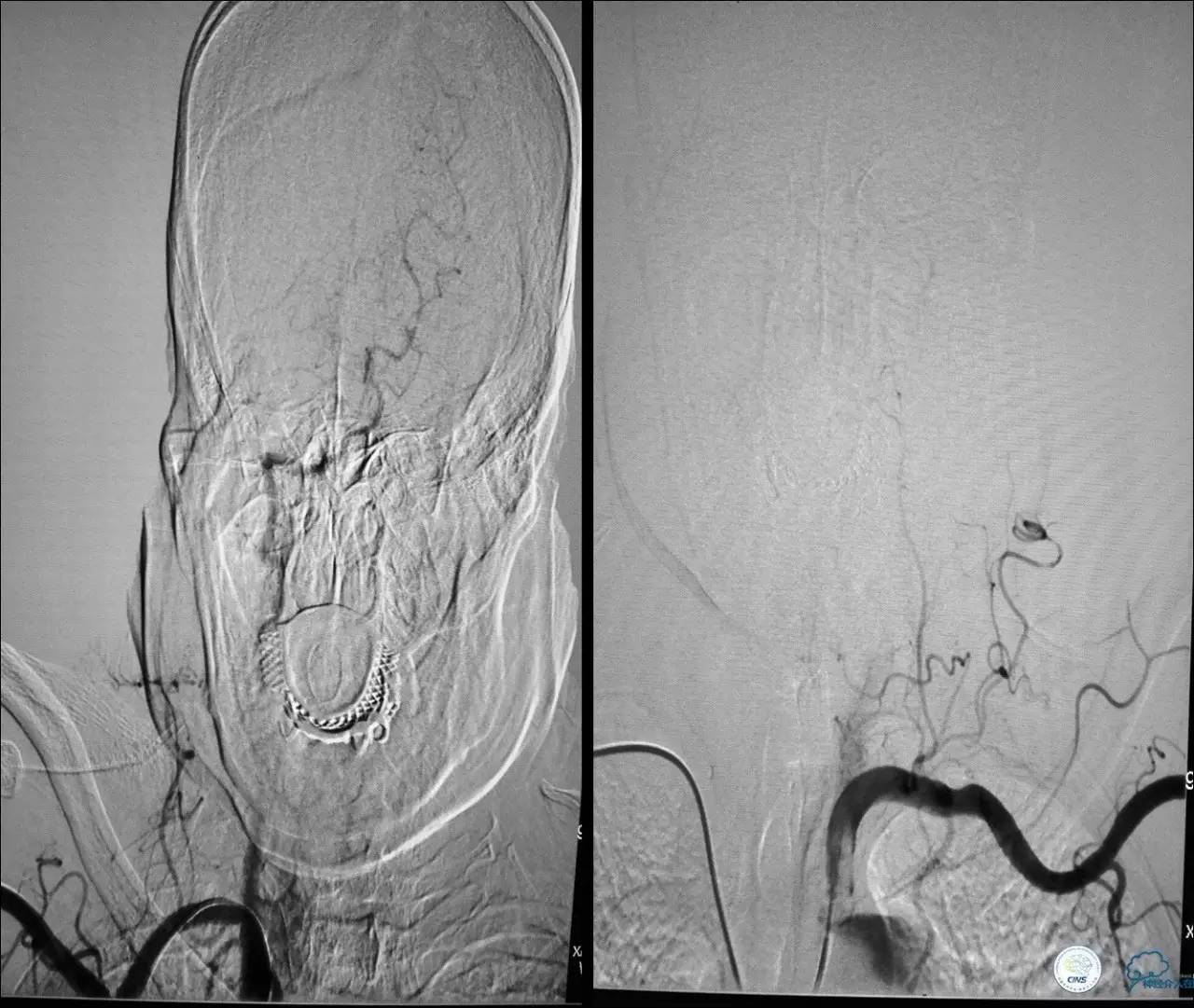 颈动脉次全闭塞,颈动脉次全闭塞中医疗法