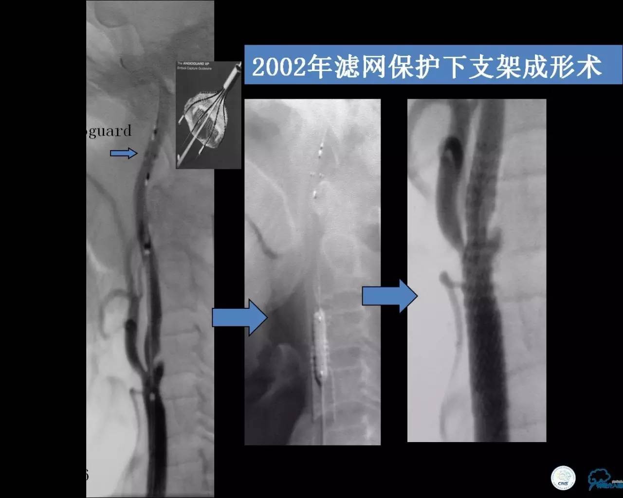 颈动脉次全闭塞,颈动脉次全闭塞中医疗法