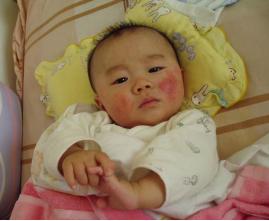 给0-3岁宝宝治疗湿疹最好用的方法都在这儿了！