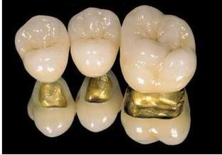 哪种镶牙材料价格又便宜又好,镶牙哪种材料最好