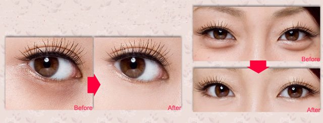 1分钟教你快速遮黑眼圈,遮瑕眼袋泪沟第一名手法