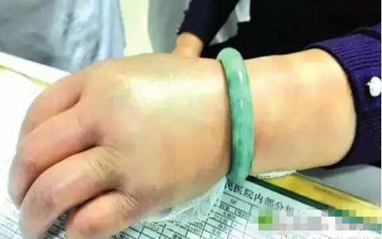 妊娠高血压出生的孩子成长案例,39岁高龄产妇生二胎凶险异常