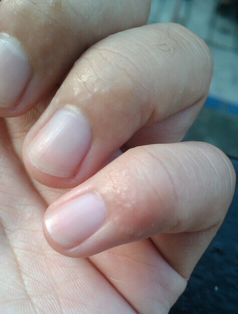 手上水泡不痒,手上有小水泡很痒怎么办