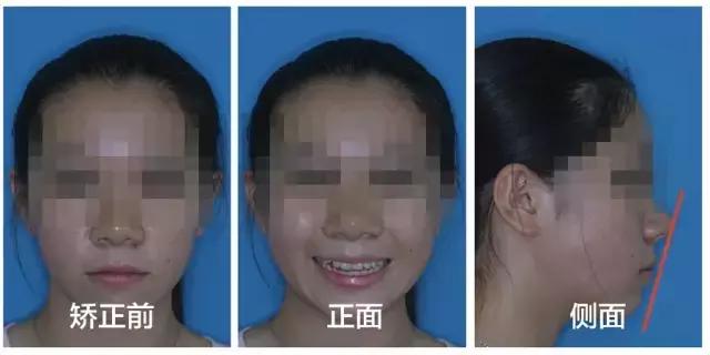 牙齿矫正是拔牙多好还是少好,为什么牙齿矫正一般都要拔牙