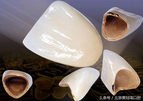 镶一口烤瓷牙到底好不好,镶的烤瓷牙有什么不习惯的吗