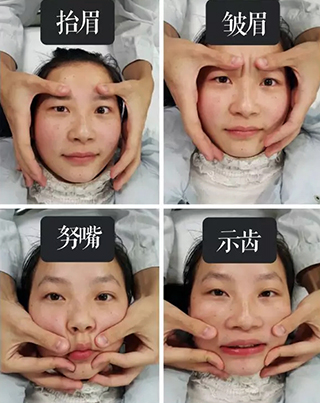 偏瘫嘴部歪训练,歪嘴改善动作