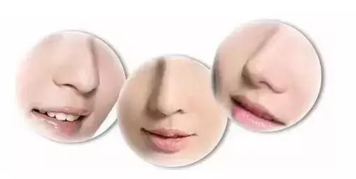 为什么鼻子隆完颜值一下就上来了,为什么隆完鼻露鼻孔还是很明显