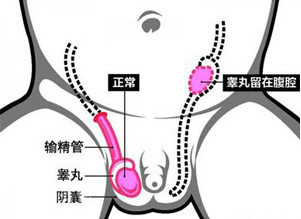 2岁男童少了一个蛋蛋，宝妈惊慌不知所措