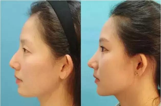 为什么鼻子隆完颜值一下就上来了,为什么隆完鼻露鼻孔还是很明显
