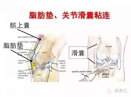 前交叉韧带重建术后关节粘连,前交叉韧带断裂术后粘连改善手法