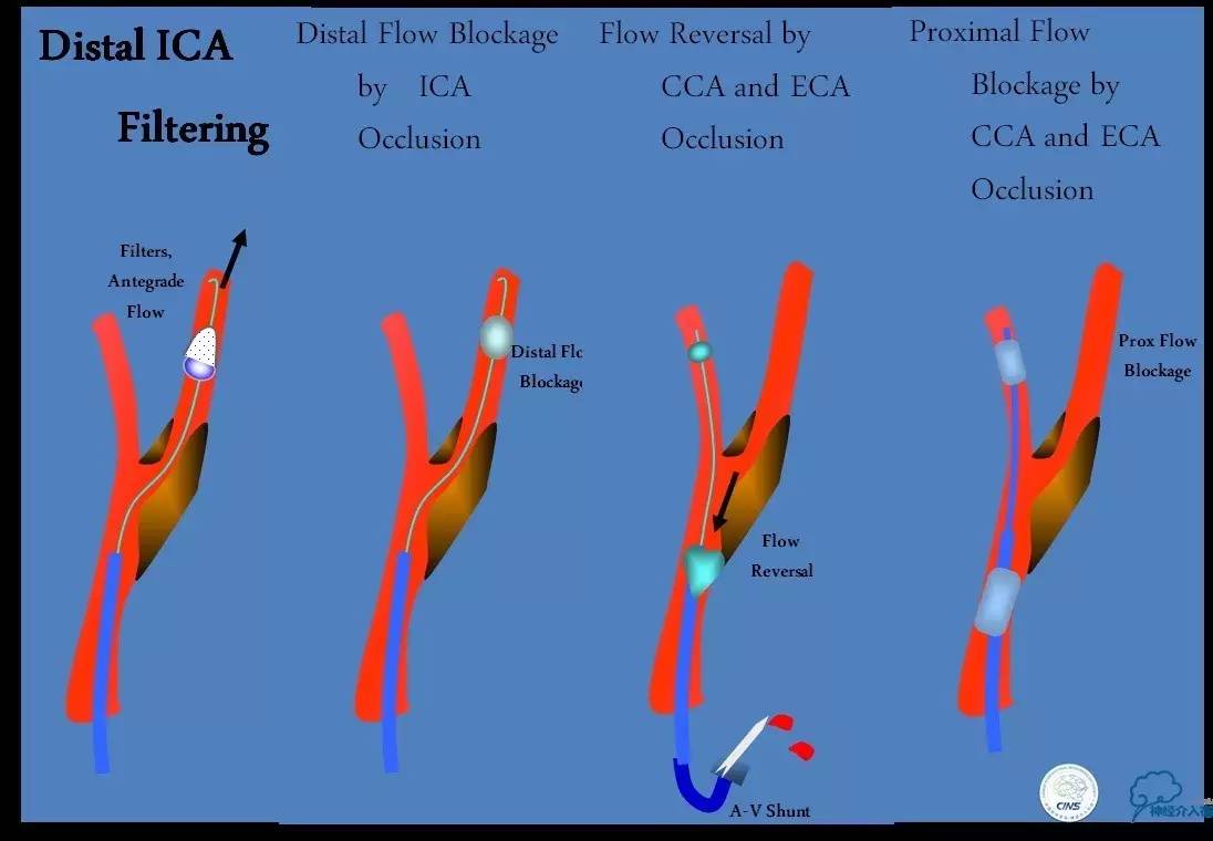 颈动脉次全闭塞,颈动脉次全闭塞中医疗法