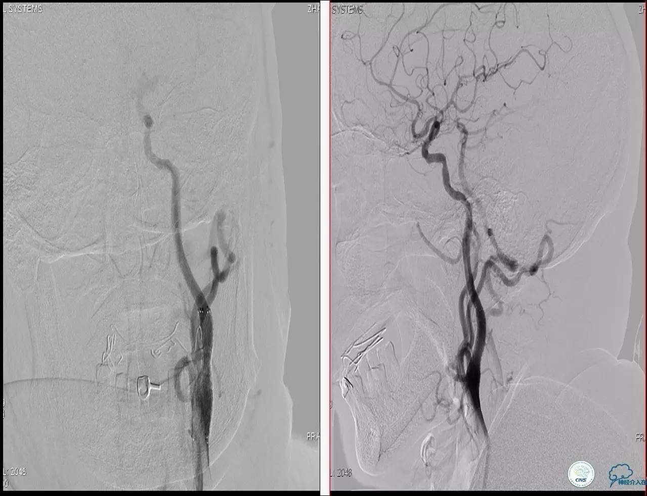 颈动脉次全闭塞,颈动脉次全闭塞中医疗法
