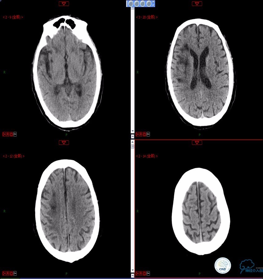 颈动脉次全闭塞,颈动脉次全闭塞中医疗法