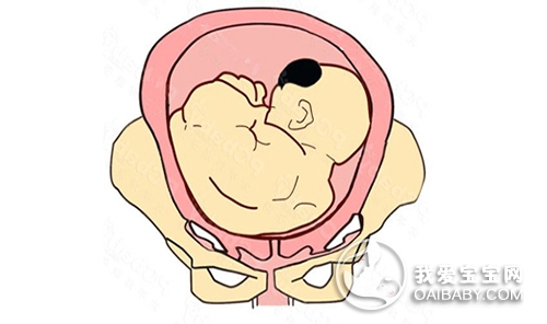 胎位不正怎么办？造成胎位不正的原因是什么？