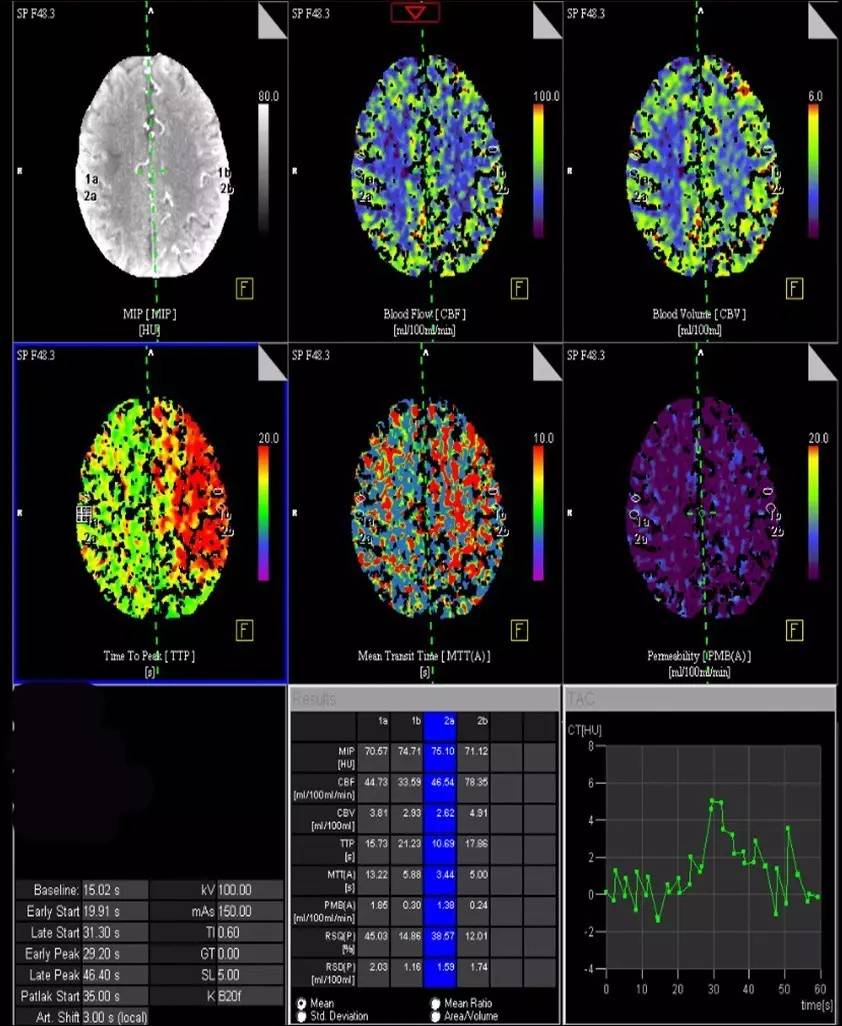 颈动脉次全闭塞,颈动脉次全闭塞中医疗法