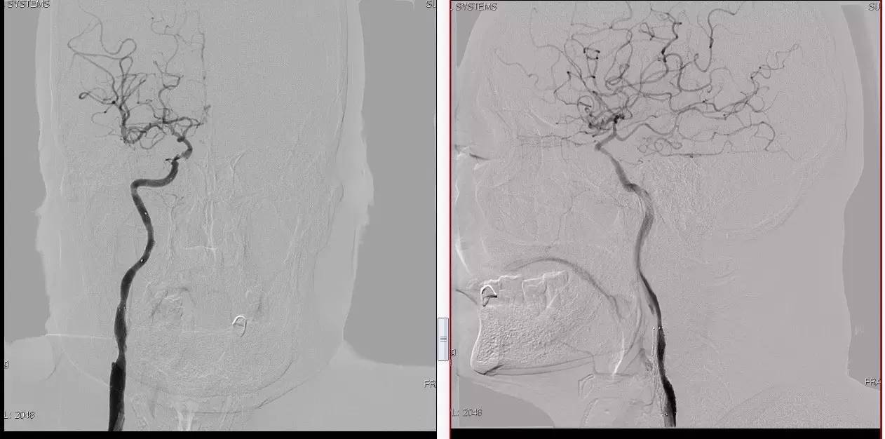 颈动脉次全闭塞,颈动脉次全闭塞中医疗法