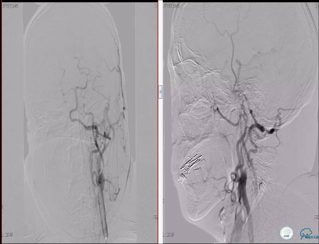 颈动脉次全闭塞,颈动脉次全闭塞中医疗法