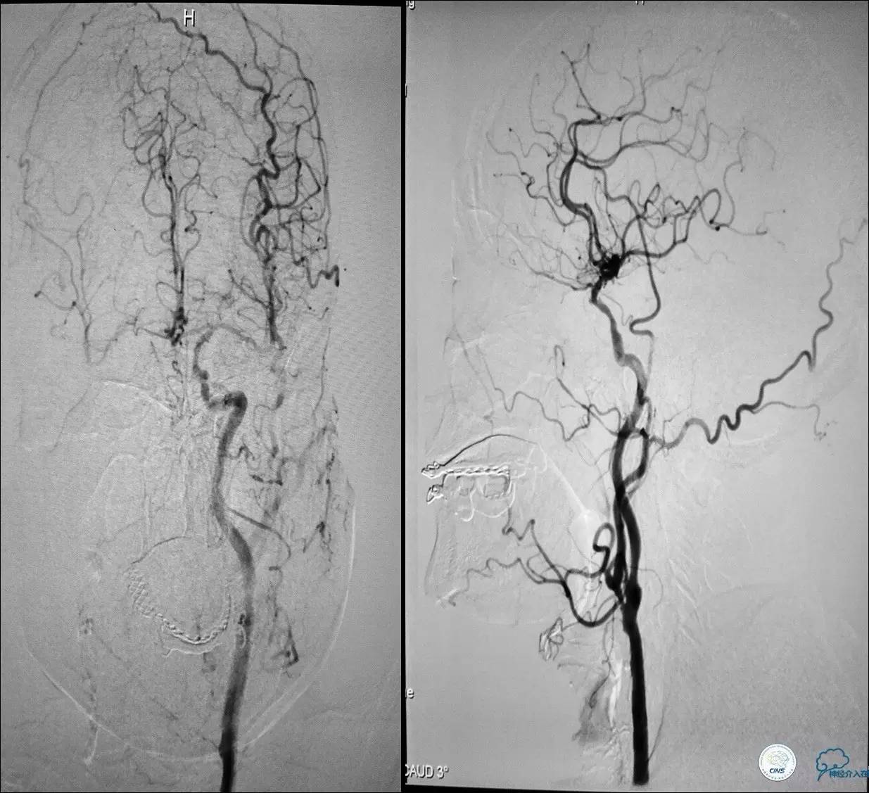 颈动脉次全闭塞,颈动脉次全闭塞中医疗法