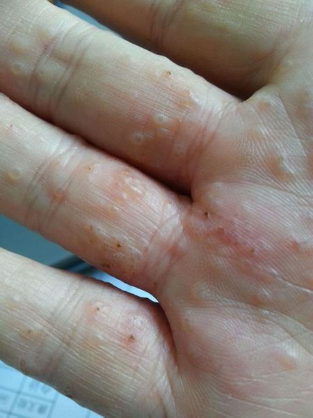 手上水泡不痒,手上有小水泡很痒怎么办
