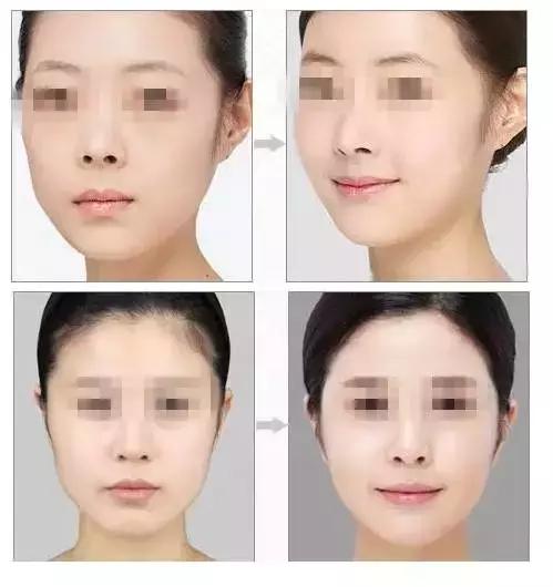 为什么鼻子隆完颜值一下就上来了,为什么隆完鼻露鼻孔还是很明显