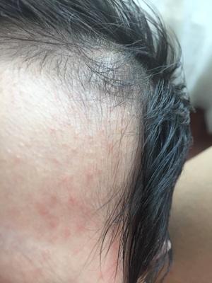 外耳道湿疹的中医治疗方法,外耳道湿疹小妙招