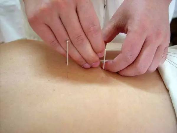 针灸穴位起什么反应,针灸针尖疼是什么反应