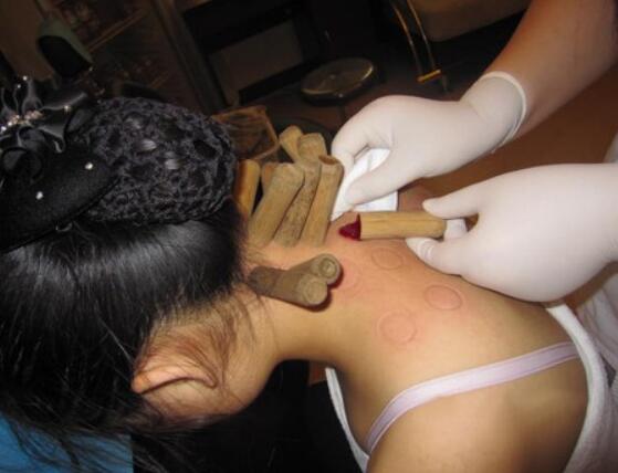 竹罐儿御医的非遗传承之路