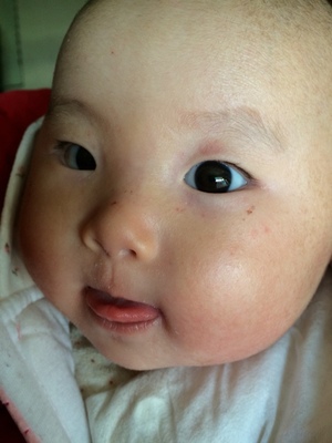 婴儿湿疹要及时不然危害是你想象不到的