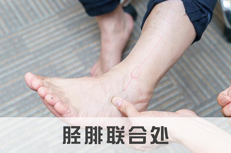 内踝应力性骨折,跟骨应力性骨折怎么治疗