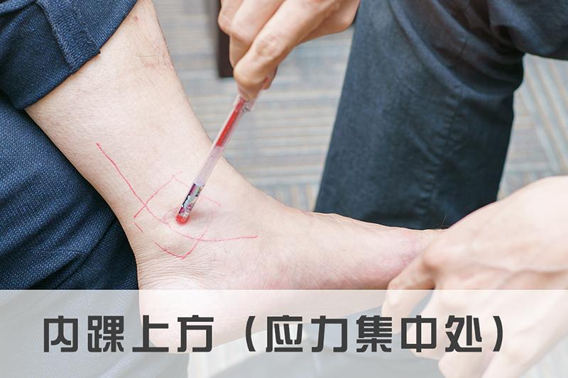 内踝应力性骨折,跟骨应力性骨折怎么治疗