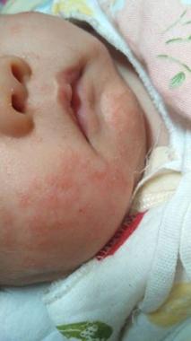 婴儿湿疹奶癣怎么护理,新生儿奶癣跟湿疹可以擦保湿霜吗