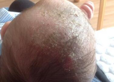 湿疹是不是春天高发,湿疹经常做这些事好得快