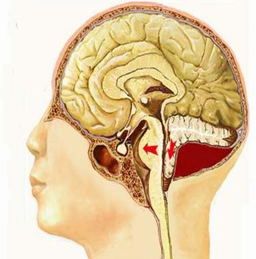 小脑扁桃体下疝畸形最佳治疗方法,小脑扁桃体下疝畸形手术治疗