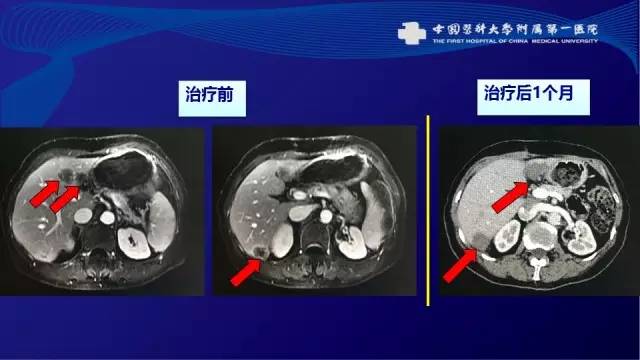 肠癌肝转移同时性和异时性,邢宝才治疗肠癌肝转移成功病例