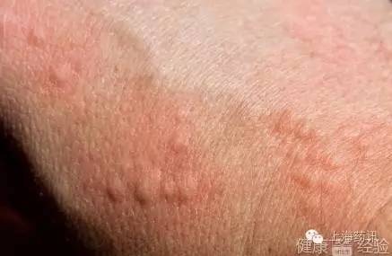 以前青霉素过敏会一直过敏吗,以前头孢过敏现在还会过敏吗