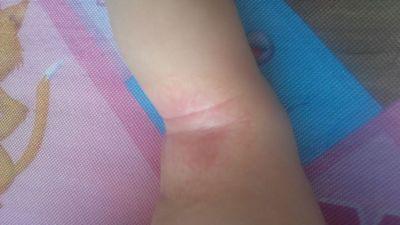 外耳道湿疹的中医治疗方法,外耳道湿疹小妙招