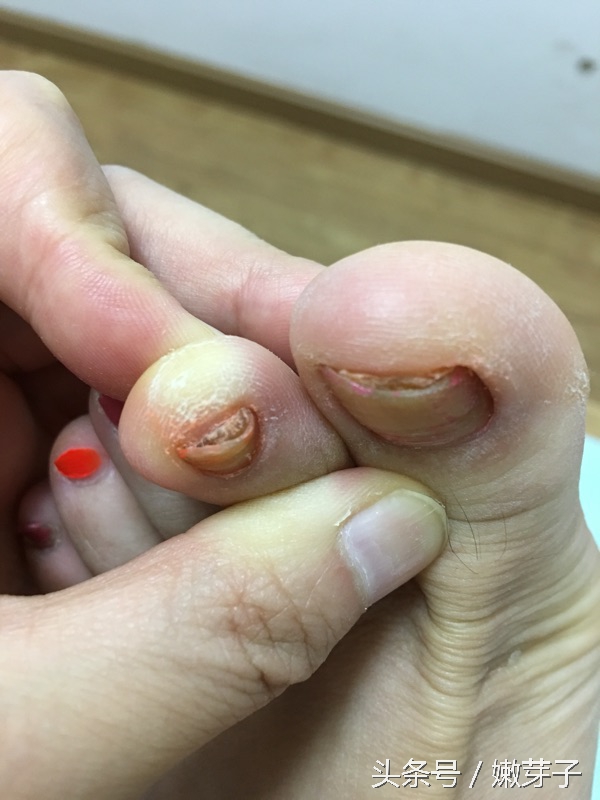 治疗灰指甲过程中需忌口吗,治灰指甲有几个阶段