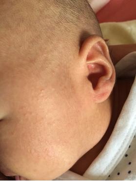 宝宝长湿疹的原因及护理方法,宝宝患湿疹的症状和治疗方法