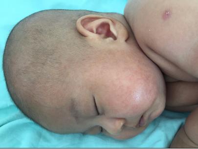 婴儿湿疹和奶粉过敏湿疹怎么区别,宝宝湿疹治疗有效的方法