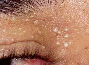 眼睛周围的扁平疣怎么消除脂肪粒,眼睛周围有脂肪粒是胆固醇高吗