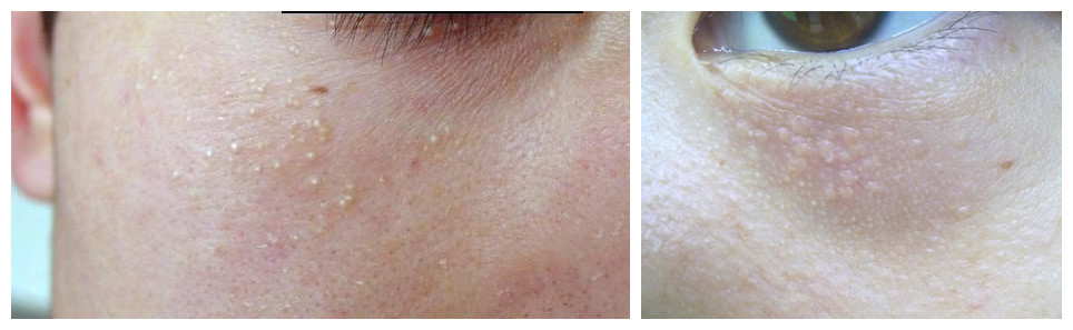 眼睛周围的扁平疣怎么消除脂肪粒,眼睛周围有脂肪粒是胆固醇高吗